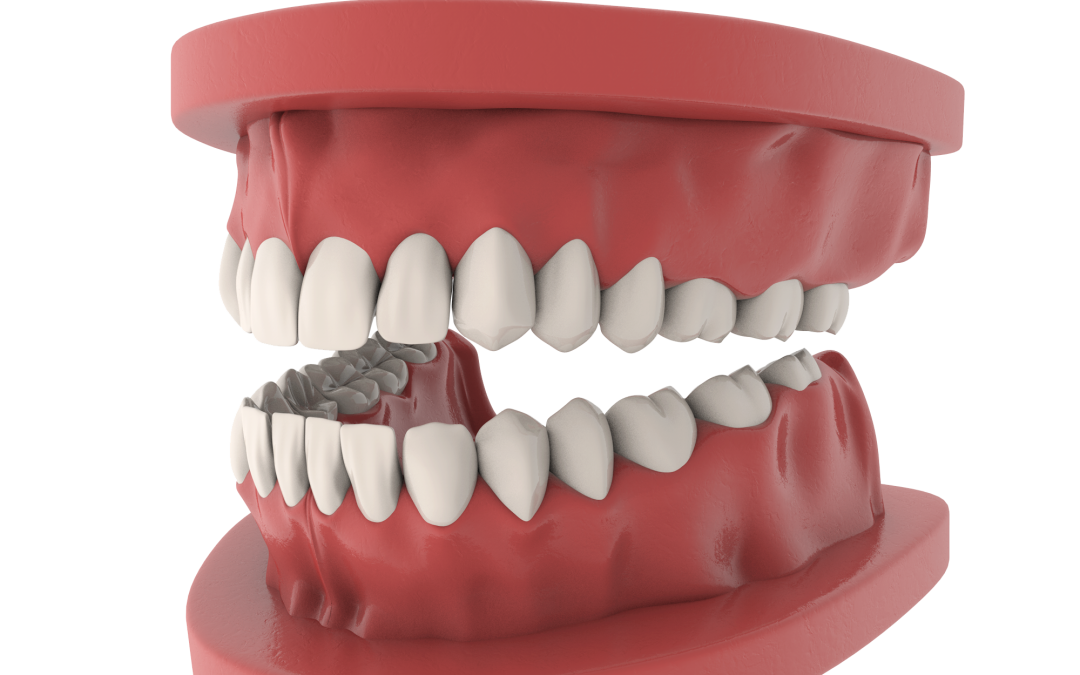 I segreti della Protesi Mobile